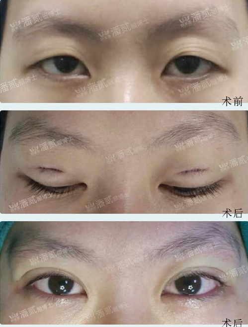 全切双眼皮1个月恢复图:全切双眼皮1个月恢复图,惊艳蜕变,真实案例全解析!