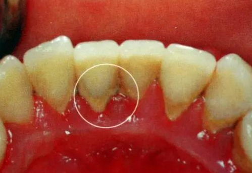 牙齿上有黑渍怎么去除:牙齿上有黑渍怎么办?这些方法帮你轻松去除