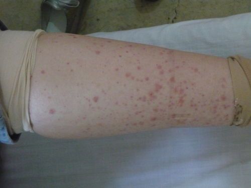 正常人身上小血点图片:正常人身上这些小红点,到底是不是病?