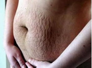 妊娠纹图片:妊娠纹,了解、预防与应对—从图片到实用建议