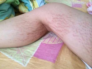 妊娠纹图片：妊娠纹，了解、预防与应对—从图片到实用建议