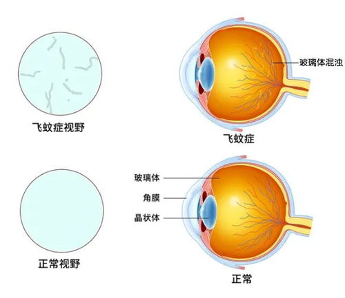 眼底出血怎么快速消除:警惕!眼底出血急救指南,快速应对与处理方法