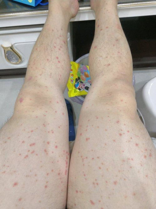 银屑病的人寿命有多长:银屑病的人寿命有多长?专家解答背后的真相