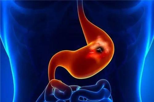 结肠炎的症状有哪些：结肠炎的症状有哪些？这些信号千万别忽视！