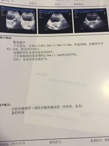 一个月来两次月经:一个月来两次月经,原因、应对与就医指南 一个月来两次月经:一个月来两次月经,原因、应对与就医指南