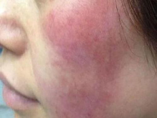 面部皮炎怎么根治：面部皮炎怎么根治？全面解析与科学应对方案