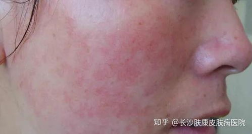 面部皮炎怎么根治：面部皮炎怎么根治？全面解析与科学应对方案