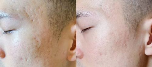 痘印痘坑怎么去除最有效的方法：痘印痘坑怎么去除最有效的方法？终极指南，告别肌肤瑕疵！