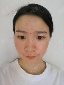 痘印痘坑怎么去除最有效的方法：痘印痘坑怎么去除最有效的方法？终极指南，告别肌肤瑕疵！