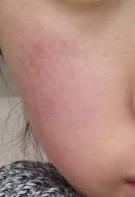 甘草酸苷治疗皮炎好了:甘草酸苷治疗皮炎,缓解炎症,带来肌肤新生