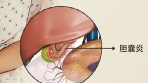 胆囊炎不能吃的9种食物：胆囊炎患者必看，这9种食物绝对不能吃！