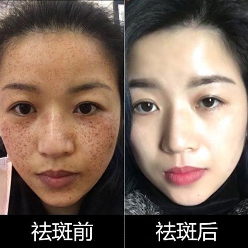 脸上痘印黑色素沉淀怎么去除：终极指南告别顽固痘印！科学方法去除脸上黑色素沉淀，重拾无瑕肌肤