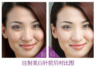 打美白针需要多少钱一次:打美白针需要多少钱一次?价格受多种因素影响 打美白针需要多少钱一次:打美白针需要多少钱一次?价格受多种因素影响