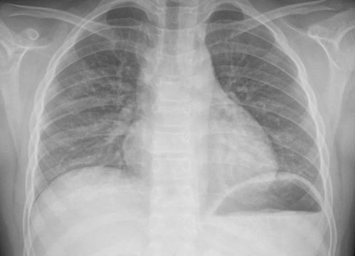 10秒自查白肺:惊爆!10秒自查白肺!这些症状你中招了吗? 10秒自查白肺:惊爆!10秒自查白肺!这些症状你中招了吗?