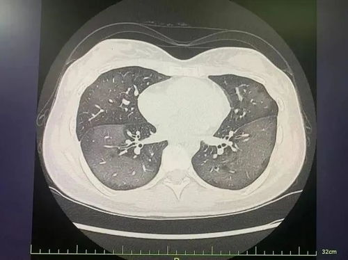 10秒自查白肺:惊爆!10秒自查白肺!这些症状你中招了吗?