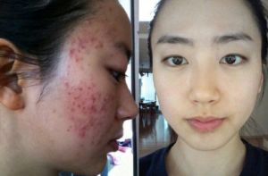 长痘是缺水还是太油:长痘是缺水还是太油?揭秘痘痘背后的真相!