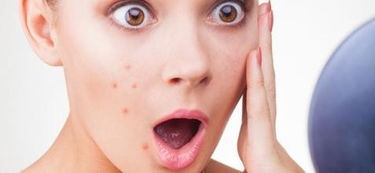 长痘是缺水还是太油:长痘是缺水还是太油?揭秘痘痘背后的真相! 长痘是缺水还是太油:长痘是缺水还是太油?揭秘痘痘背后的真相!