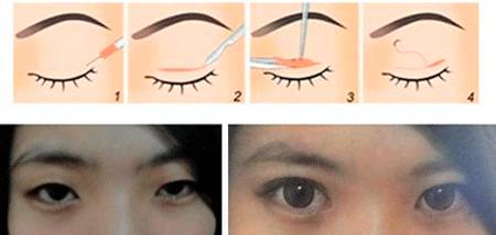 割双眼皮20年后:镜中重逢,割双眼皮手术二十年后的光影变迁