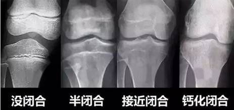 查骨龄的最佳年龄是多少:孩子长高看骨龄,最佳检测时间你知道吗?