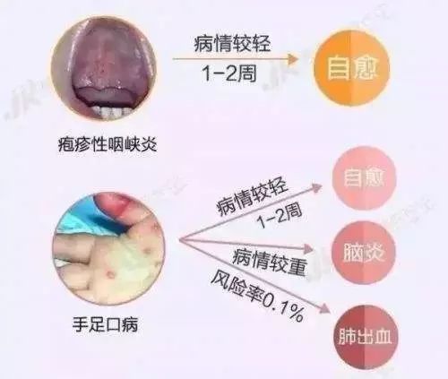 疱疹会传染吗：疱疹会传染吗？全面解析与预防指南