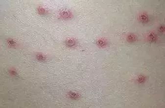 疱疹会传染吗：疱疹会传染吗？全面解析与预防指南