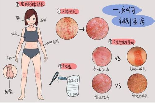 湿疹有渗出液怎么涂药：湿疹有渗出液？正确涂药方法全解析，告别反复困扰！
