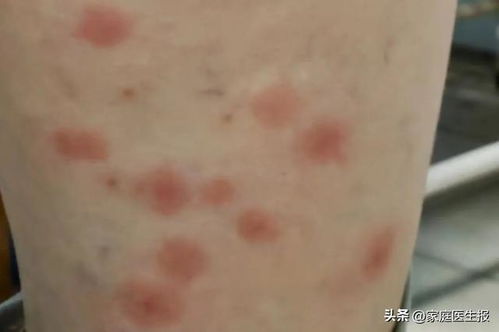 丘疹性荨麻疹怎么治疗最快:丘疹性荨麻疹最快治疗方法 丘疹性荨麻疹怎么治疗最快:丘疹性荨麻疹最快治疗方法