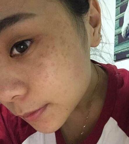 面部有脂肪粒怎么去除：面部脂肪粒困扰？这些方法帮你轻松去除，恢复光滑肌肤！