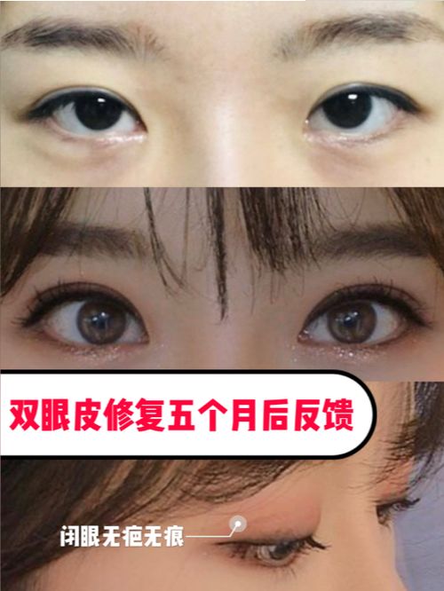 双眼皮做了十几年了还能修复吗：双眼皮做了十几年还能修复吗？专业医生告诉你答案！