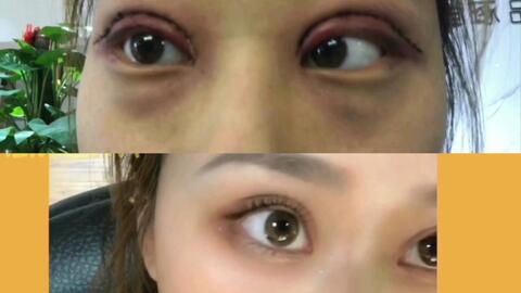 双眼皮做了十几年了还能修复吗：双眼皮做了十几年还能修复吗？专业医生告诉你答案！