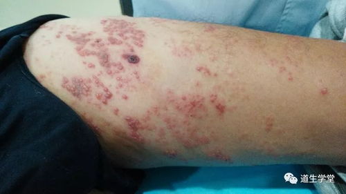 慢性荨麻疹的有效治疗方法：慢性荨麻疹的有效治疗方法，突破困扰的黄金三联疗法？