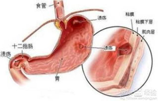 肠炎怎么分辨细菌还是病毒:肠炎怎么分辨细菌还是病毒?这些症状和判断方法请收好! 肠炎怎么分辨细菌还是病毒:肠炎怎么分辨细菌还是病毒?这些症状和判断方法请收好!