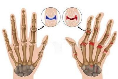 祖师麻能根除类风湿吗：祖师麻能根除类风湿吗？揭秘真相与误区