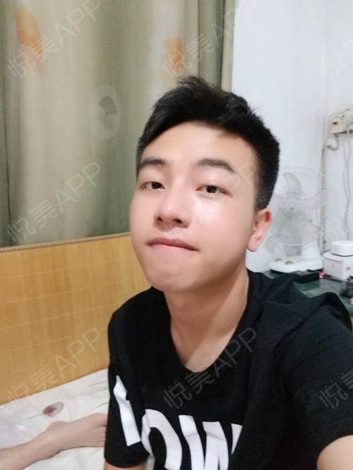 隆鼻手术后多久可以完全恢复正常:隆鼻手术后多久可以完全恢复正常?全面解析恢复时间线 隆鼻手术后多久可以完全恢复正常:隆鼻手术后多久可以完全恢复正常?全面解析恢复时间线