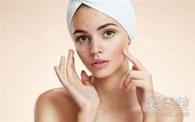 脸上的痘印怎么消除最快最安全:告别顽固痘印!最快最安全的淡化方法全解析 脸上的痘印怎么消除最快最安全:告别顽固痘印!最快最安全的淡化方法全解析