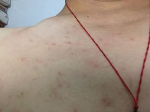 脂溢性皮炎可以自愈吗：脂溢性皮炎可以自愈吗？权威解答来了！