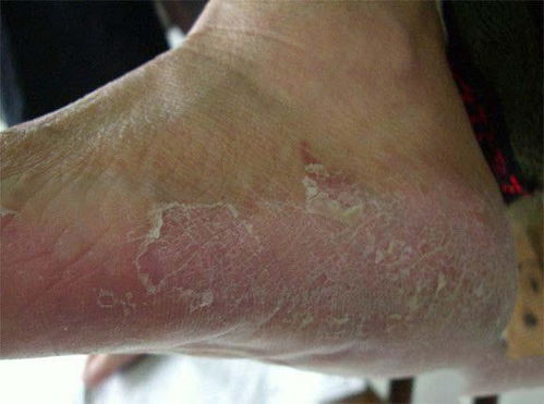 脚气真菌感染用什么药好：脚气真菌感染用什么药好？全面解析治疗方案与用药注意事项