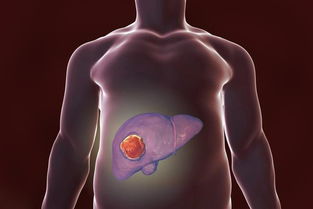 肝硬化到肝癌一般几年:肝硬化到肝癌一般需要几年? 肝硬化到肝癌一般几年:肝硬化到肝癌一般需要几年?