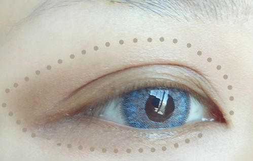 下眼睑凹陷填充什么最好：下眼睑凹陷填充什么最好？2023年最适合的填充方案全面解析