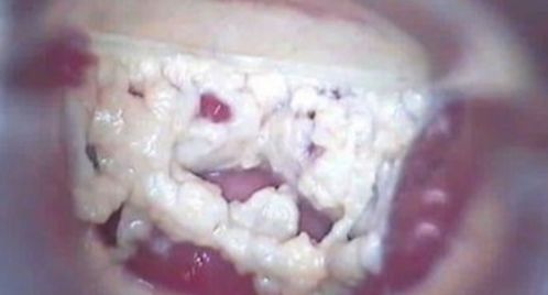 长期霉菌性阴严重后果:警惕长期霉菌性阴道炎的严重后果,不可忽视的健康隐患!