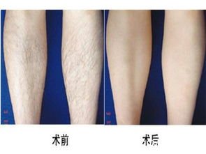 去腿毛激光要多少费用:激光去腿毛要多少费用?全面解析影响价格的关键因素