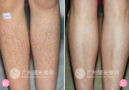 去腿毛激光要多少费用：激光去腿毛要多少费用？全面解析影响价格的关键因素