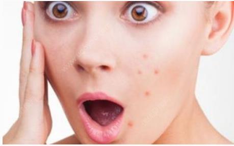 痤疮好了还会复发吗：痤疮真的会复发吗？看完这篇你就明白了