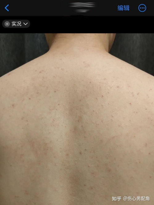 痤疮好了还会复发吗：痤疮真的会复发吗？看完这篇你就明白了