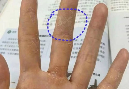 各种湿疹图片:湿疹图片大全,认识不同类型的湿疹症状与表现(全图解析)