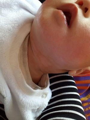 湿疹最怕的一个克星:湿疹最怕的一个致命误区,你中招了吗? 湿疹最怕的一个克星:湿疹最怕的一个致命误区,你中招了吗?