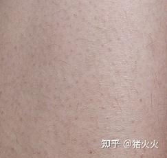 鸡皮肤图片及症状图片:认识鸡皮肤,症状、成因与图片解读