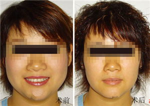 瘦脸手术大概需要多少钱:瘦脸手术价格解析,了解费用构成,做出明智选择