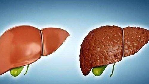肝脏开始变硬有6种迹象：肝脏开始变硬有6种迹象，你中招了吗？