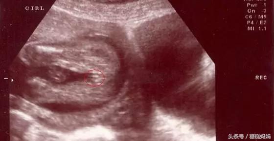 四维有这个一般是男孩:四维彩超与胎儿性别,真相与科学解读